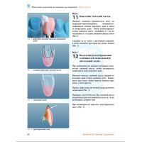 Нанесение керамики. Передние и боковые зубные протезы (Фото 8)