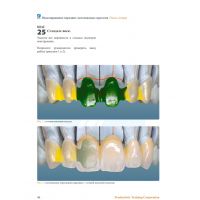 Создание каркасов несъемных зубных протезов (Фото 7)